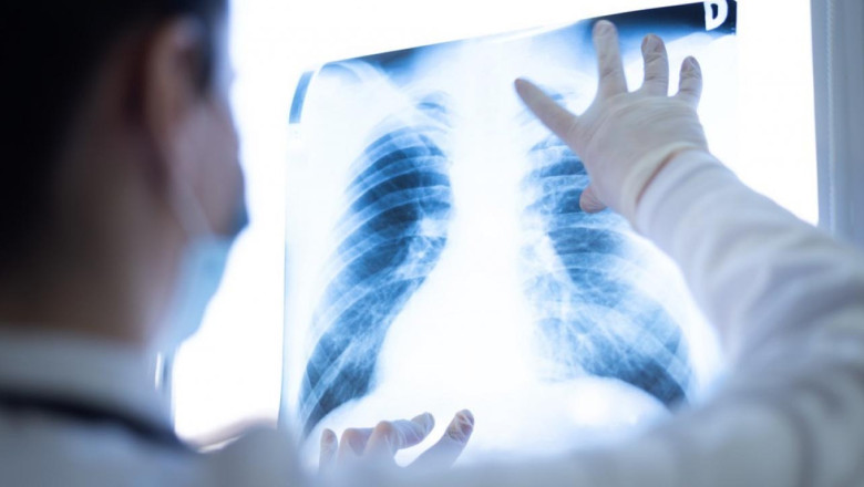 İl Sağlık Müdürlüğü, Pulmoner Rehabilitasyon Öneriyor!