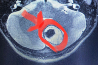 YALOVA DEVLET HASTANESİN'DEN BİR İLK DAHA