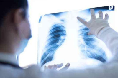 Yalova İl Sağlık Müdürlüğü: “Kasım Ayı Akciğer Kanseri Farkındalık Ayı – Erken Tanı Hayat Kurtarır”